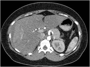 CT scan of the lesion