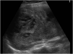Ultrasound scan of a 32 year old female patient also using oral contraceptives. She had severe pain in the right abdomen