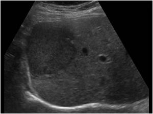 Ultrasound scan of a 36 year old patient with slightly hypoechoic but homogeneous mass lesions also using oral contraceptives. The lesions were incidental findings.