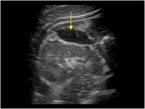 Transverse image of the right kidney with fluid collection
