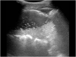 Another image of the bowel with air in the wall