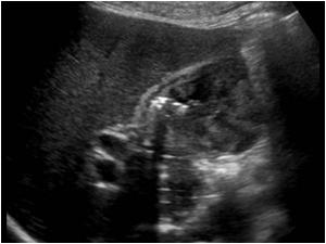 Abnormal gallbladder with air in the lumen