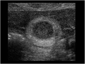 Cholecystitis with a thickened gallbladder wall transverse