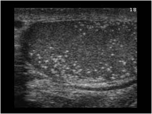 Microlithiasis right testicle