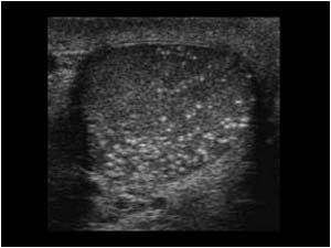 Microlithiasis right testicle