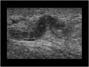 Trombus filled scrotal vein