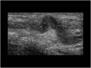 Trombus filled scrotal vein