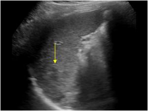 Longitudinal image of the spleen with a subtle abnormality after blunt abdominal trauma