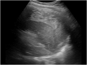 Transverse image of the spleen with a large perisplenic hematoma