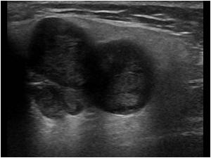 pleomorphic adenoma submandibular gland ultrasound