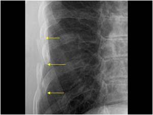 Multiple displaced rib fractures X ray