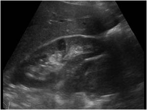 Longitudinal image of the right kidney with a mass impressing the lowerpole