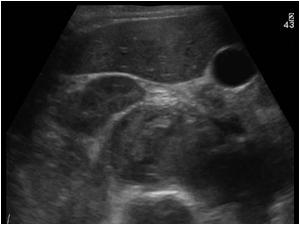 Transverse image of the same mass impressing the right kidney