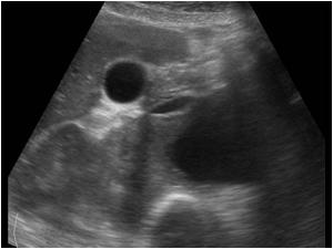 Transverse image showing the hematoma arising from the aneurysm.The patient had a ruptured abdominal aneurysme with a large retroperitoneal hematoma impressing the kidney