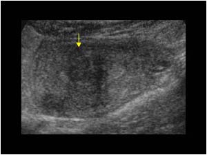 Submucosal fibroid with a hypoechoic mass transverse