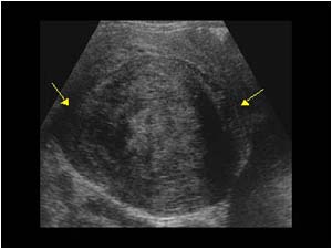 Very large subserosal fibroid on the dorsal aspect of the uterus