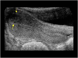 Small fibroid in the fundus of the uterus longitudinal