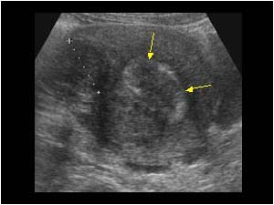 Hypoechoic fibroids and one with curvilinear calcifications