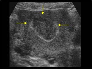Fibroids with curvilinear calcifications