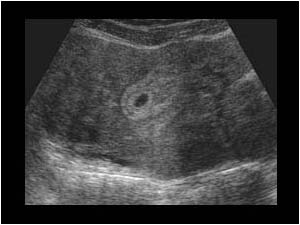 Uterine fibroids and a gestational sac