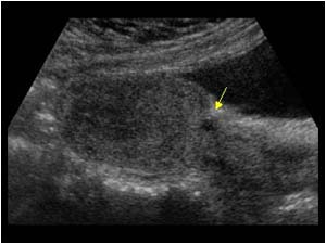 Irregularity on the lower anterior aspect of the uterus