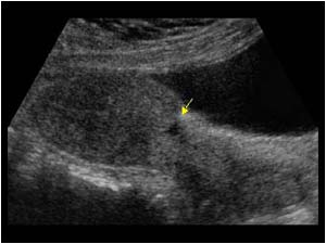 Irregularity on the lower anterior aspect of the uterus