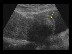 Hematoma on the lower anterior aspect of the uterus longitudinal
