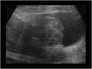 Hematoma on the lower anterior aspect of the uterus longitudinal