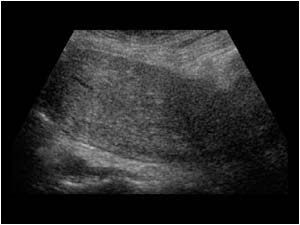 Normal fudus of the uterus longitudinal