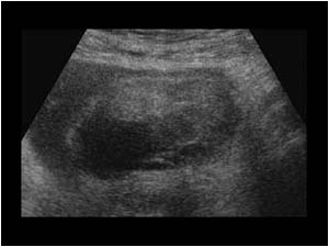Hematoma on the lower anterior aspect of the uterus transverse