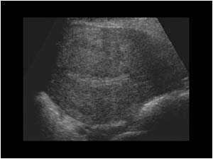 Normal fundus of the uterus
