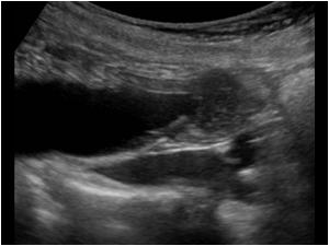 Detail of the common bile duct ending in a rounded mass