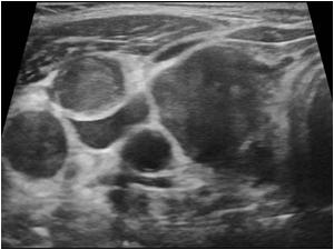 Transverse image of the abnomal lymph nodes
