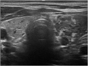 Transverse image of the abnomal thyroid gland of a 55 year old female