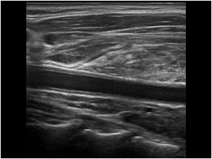 Longitudinal image of the mass around the carotid artery