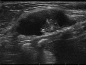 Intracystic mass in a midline cyst cranial to the thyroid
