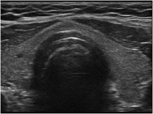 Transverse image of the normal thyroid