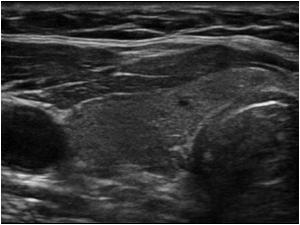 Transverse image of a normal right thyroid lobe