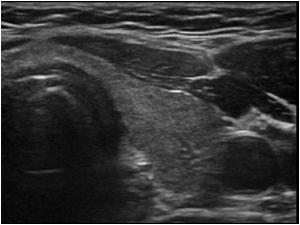 Transverse image of a normal left thyroid lobe