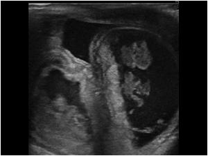 The following case is also a male patient 26 year old With a painful swollen scrotum. The image shows dilatated small bowel loops in the scrotum.