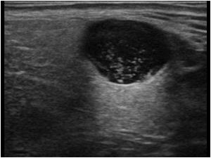 Image of a similar mass in a 68 year old male patient