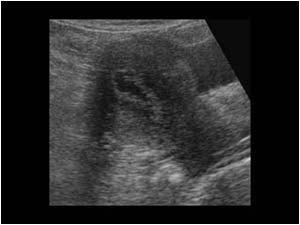 Irregular fluid filled uterine cavity longitudinal