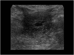Irregular fluid filled uterine cavity transverse