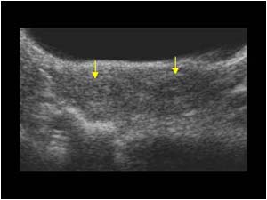Bicornuate uterus transverse showing 2 endometria