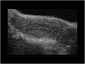 Bicornuate uterus longitudinal showing left endometrium