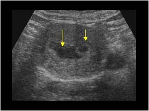 Small empty gestational sac and fluid in the uterine cavity transverse