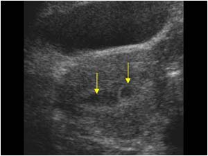 Small empty gestational sac and fluid in the uterine cavity