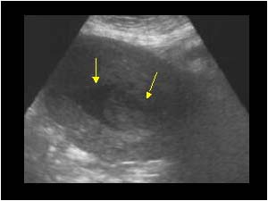 Polypoid endometrium and fluid filled endometrial canal
