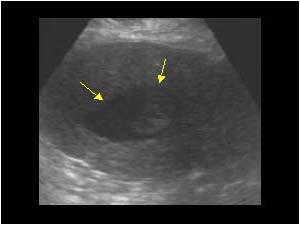 Polypoid endometrium and fluid filled endometrial canal