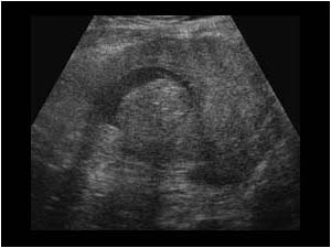 Polypoid mass and fluid filled endometrial canal